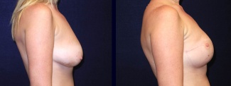 Right Profile View - Breast Reconstruction