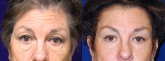 Fontal View - Upper & Lower Eyelid Surgery with Browlift