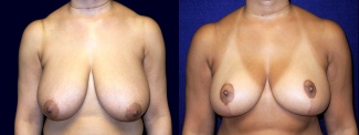 Frontal View - Breast Reduction