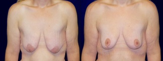 Frontal View - Breast Lift After Weight Loss