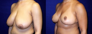 Left 3/4 View - Breast Reduction