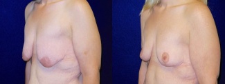 Left 3/4 View - Breast Lift After Weight Loss