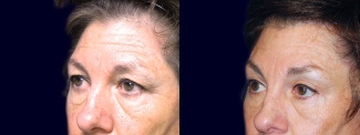 Left 3/4 View - Upper & Lower Eyelid Surgery with Browlift