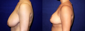 Left Profile View - Breast Reduction