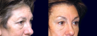 Right 3/4 View - Upper & Lower Eyelid Surgery with Browlift