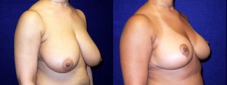 Right 3/4 View - Breast Reduction