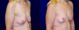 Right 3/4 View - Breast Lift After Weight Loss