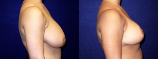 Right Profile View - Breast Reduction