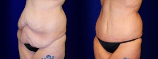 Left 3/4 View - Tummy Tuck After Weight Loss