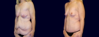 Left 3/4 View - Surgery After Weight Loss - Breast Lift & Tummy Tuck