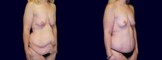 Right 3/4 View - Surgery After Weight Loss - Breast Lift & Tummy Tuck