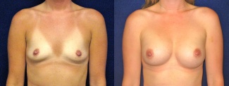 Frontal View - Breast Augmentation