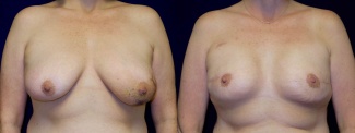 Frontal View - Breast Reconstruction