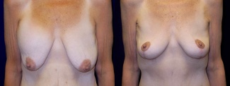 Frontal View - Breast Lift After Weight Loss