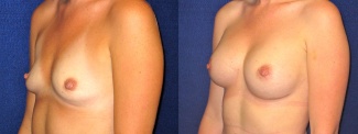 Left 3/4 View - Breast Augmentation