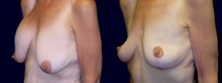 Left 3/4 View - Breast Lift After Weight Loss