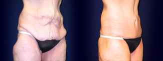 Right 3/4 View - Tummy Tuck After Massive Weight Loss
