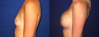 Left Profile View - Breast Augmentation