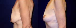 Left Profile View - Breast Lift After Weight Loss