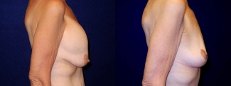 Right Profile View - Breast Lift After Weight Loss