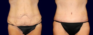 Frontal View - Tummy Tuck After Weight Loss