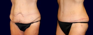 Left 3/4 View - Tummy Tuck After Weight Loss