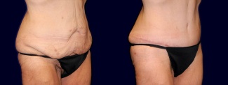 Right 3/4 View - Tummy Tuck After Weight Loss