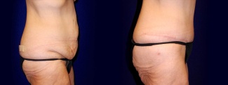 Right Profile View - Tummy Tuck After Weight Loss