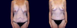 Frontal View - Surgery After Weight Loss - Breast Lift & Tummy Tuck