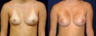 Frontal View - Breast Augmentation - Silicone Implants