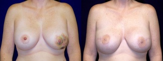 Frontal View - Breast Reconstruction