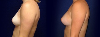 Left Profile View - Breast Augmentation - Silicone Implants