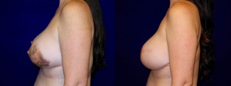 Left Profile View - Breast Reconstruction