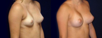 Right 3/4 View - Breast Augmentation - Silicone Implants