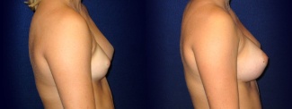 Right Profile View - Breast Augmentation - Silicone Implants