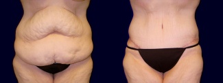 Frontal View - Tummy Tuck After Weight Loss