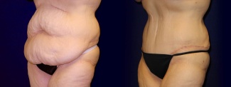 Left 3/4 View - Tummy Tuck After Weight Loss