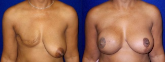 Frontal View - Breast Reconstruction