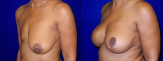 Left 3/4 View - Breast Reconstruction