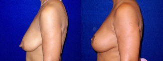 Left Profile View - Breast Reconstruction