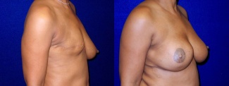 Right 3/4 View - Breast Reconstruction