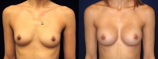 Frontal View - Breast Augmentation - Silicone Implants