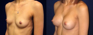 Left 3/4 View - Breast Augmentation - Silicone Implants