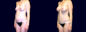 Left 3/4 View - Breast Augmentation & Abdominoplasty