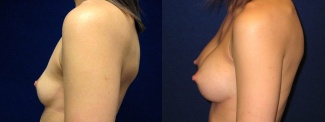 Left Profile View - Breast Augmentation - Silicone Implants