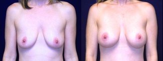 Frontal View - Breast Augmentation