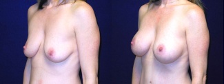 Left 3/4 View - Breast Augmentation