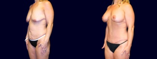 Left 3/4 View - Breast Augmentation with Lift & Tummy Tuck