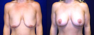 Frontatl View - Breast Augmentation with Lift
