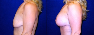 Left Profile View - Breast Augmentation with Lift